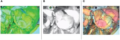 Indocyanine Green to Assess Vascularity of Ileal Conduit Anastomosis During Pelvic Exenteration for Recurrent/Persistent Gynecological Cancer: A Pilot Study